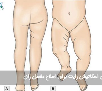 بریس اسکاتیش رایت برای اصلاح مفصل ران