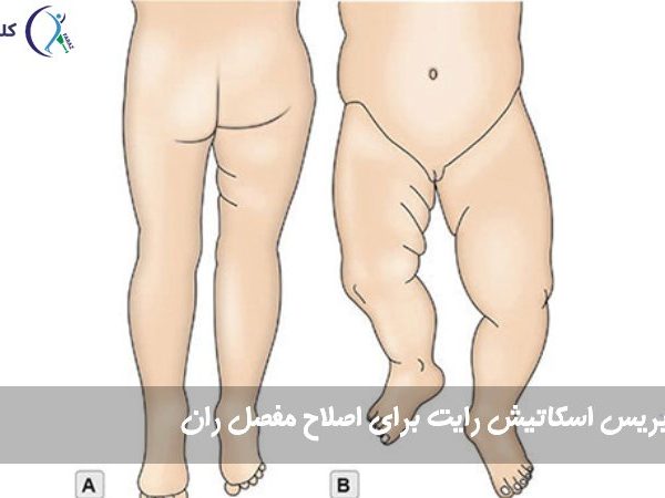 بریس اسکاتیش رایت برای اصلاح مفصل ران