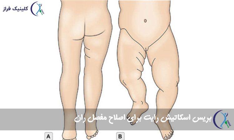 بریس اسکاتیش رایت برای اصلاح مفصل ران