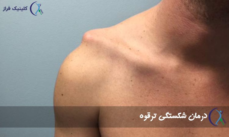 درمان شکستگی ترقوه