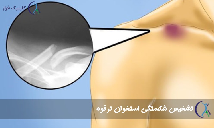 تشخیص شکستگی ترقوه