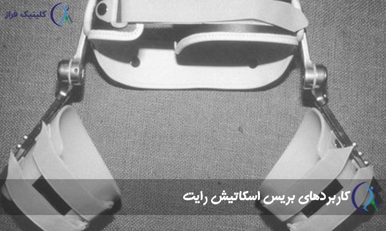 کاربردهای بریس اسکاتیش رایت