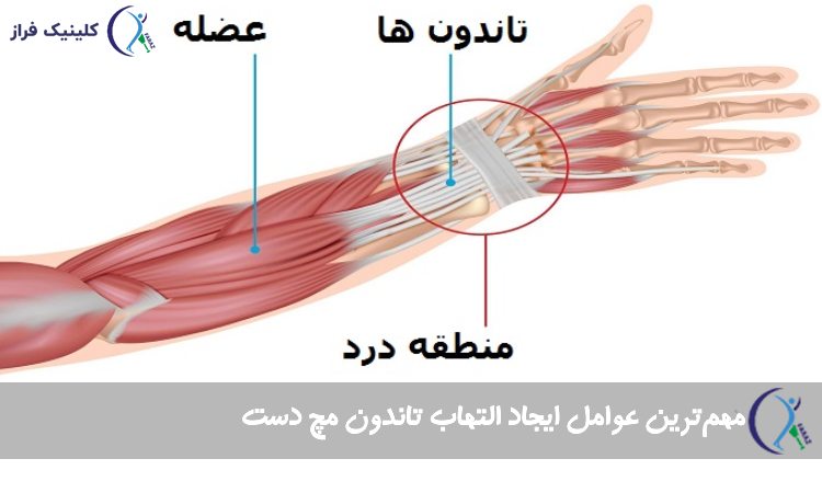 مهم‌ترین عوامل ایجاد التهاب تاندون مچ دست