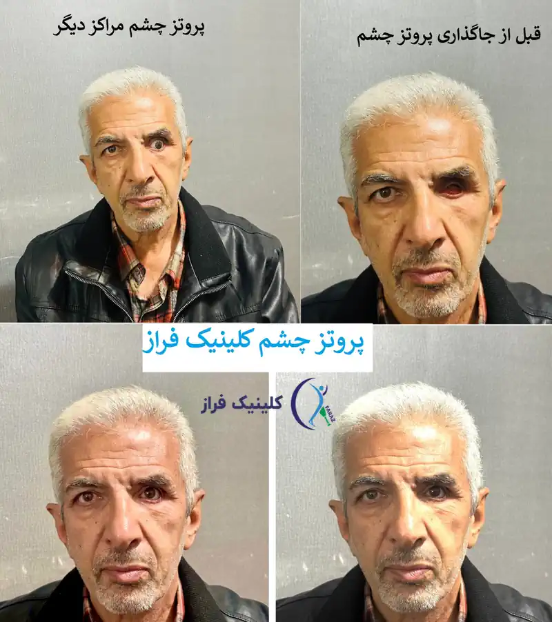 مقایسه پروتز چشم کلینیک فراز با برخی از مراکز نامعتبر