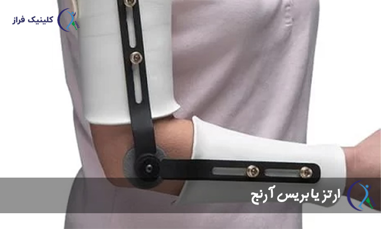 ارتز یا بریس آرنج