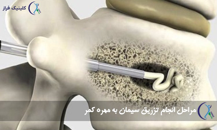 مراحل انجام تزریق سیمان به مهره کمر
