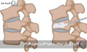تزریق سیمان به مهره کمر