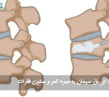 تزریق سیمان به مهره کمر