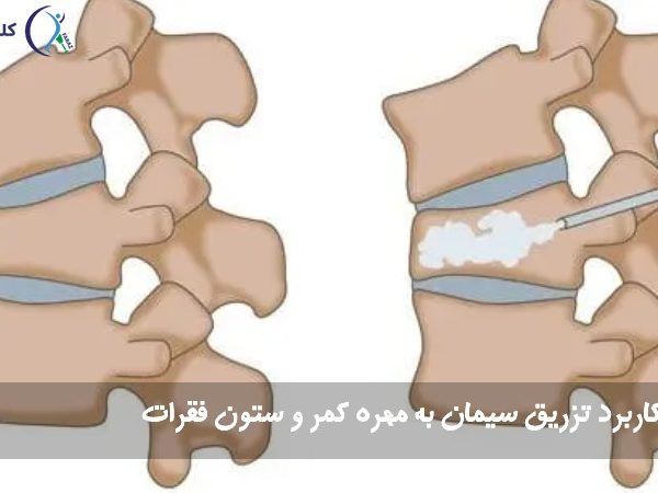 تزریق سیمان به مهره کمر