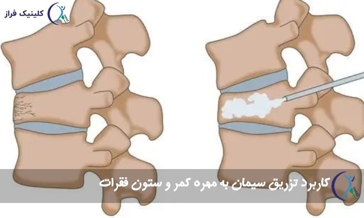تزریق سیمان به مهره کمر