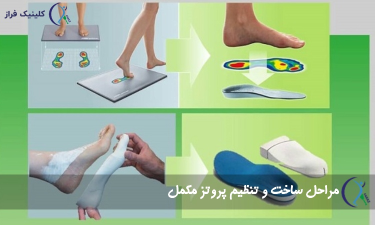 مراحل ساخت و تنظیم پروتز مکمل