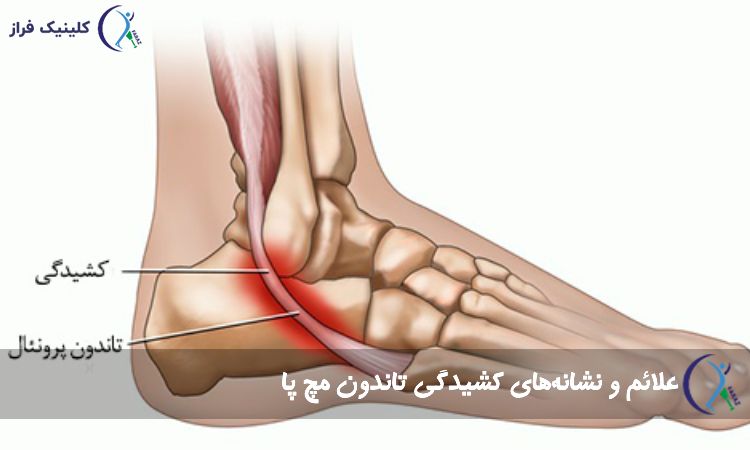 نشانه‌های کشیدگی تاندون مچ پا