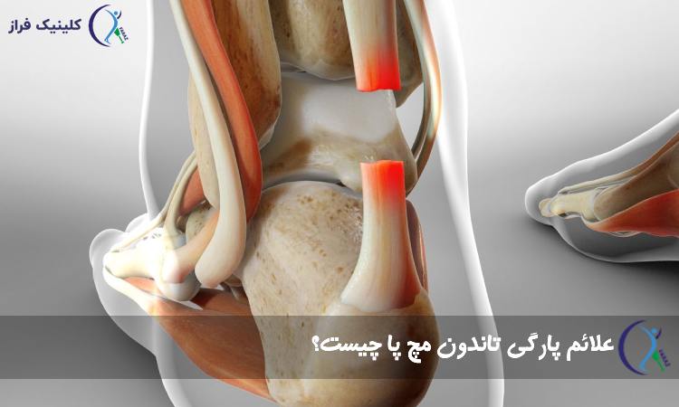 علائم پارگی تاندون مچ پا چیست؟