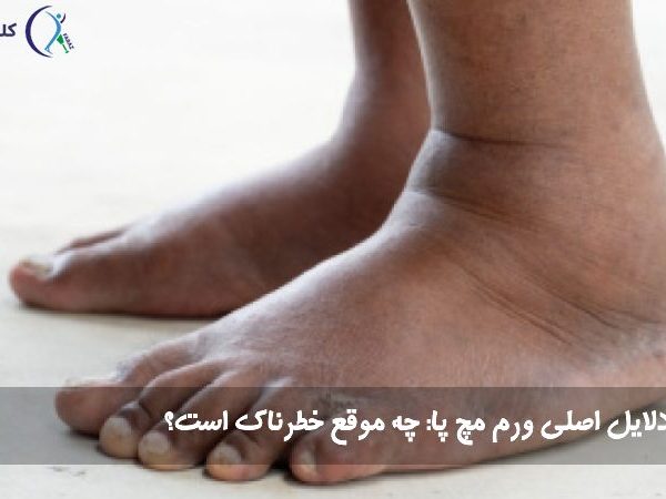 ورم مچ پا