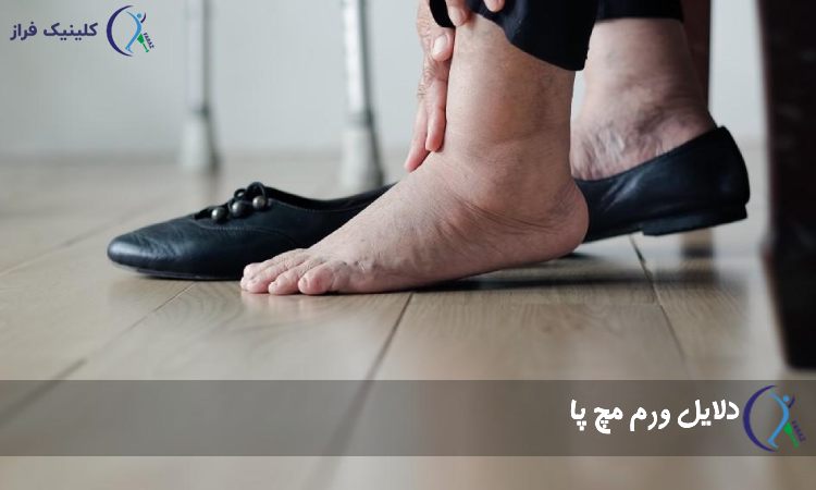 دلایل ورم مچ پا