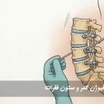 جراحی فیوژن کمر و ستون فقرات