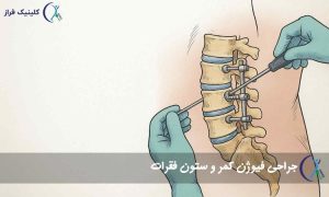 جراحی فیوژن کمر و ستون فقرات