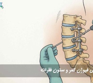جراحی فیوژن کمر و ستون فقرات