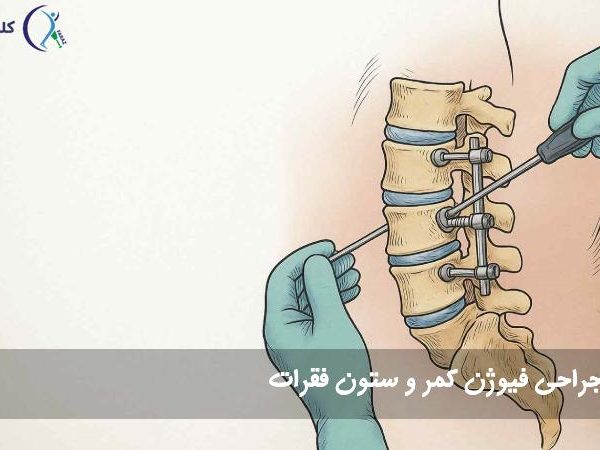 جراحی فیوژن کمر و ستون فقرات