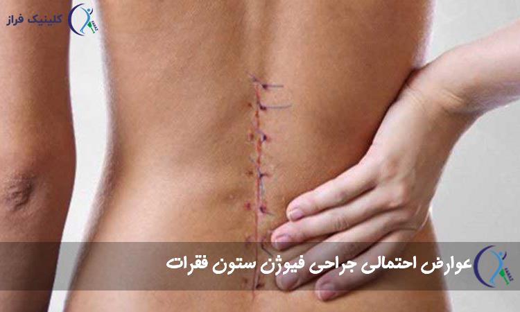 عوارض احتمالی جراحی فیوژن ستون فقرات
