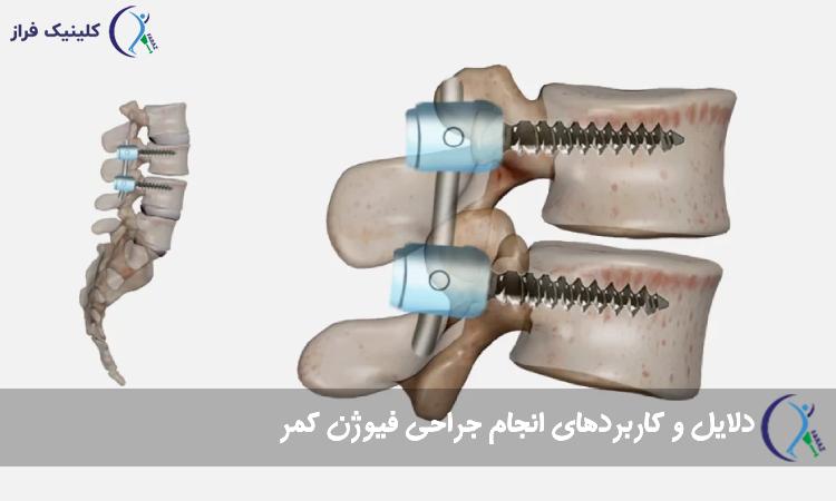 فیوژن ستون فقرات