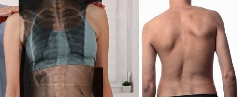 اسکولیوز چیست | و درمان انحراف ستون فقرات بزرگسالان