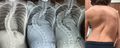 انحراف ستون فقرات به راست